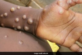 अमेरिकामा मंकीपक्स भाइरस देखिएपछि सावधानी अपनाउन आग्रह